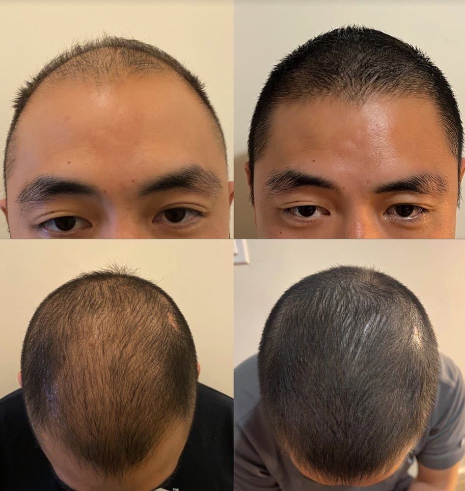Barber Surgeons Guild - hair transplant in New York, NY