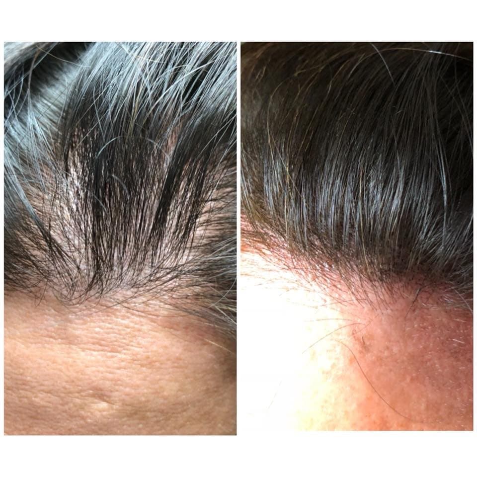 Hair Ink - hair transplant in Rochester, NY