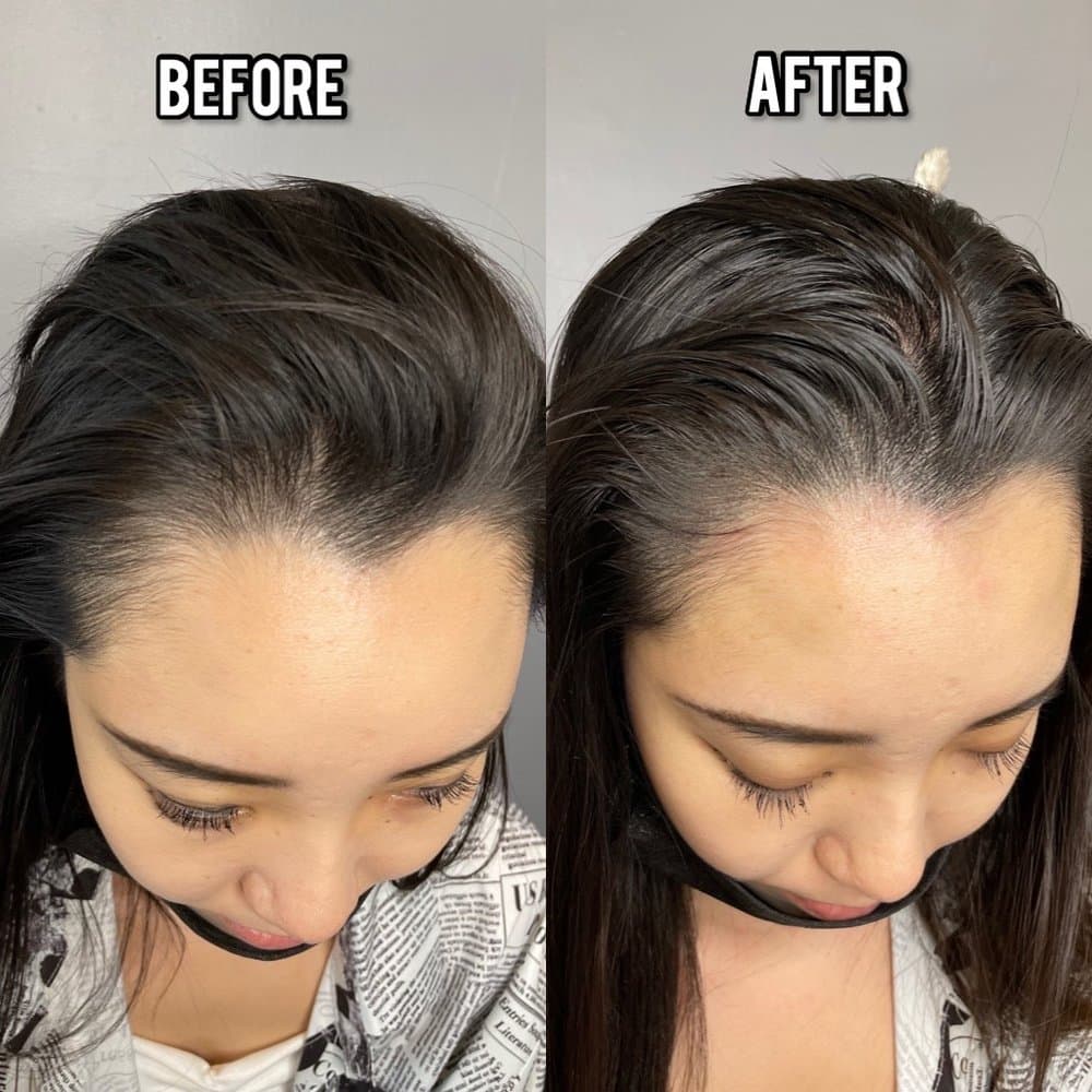 Roger Does SMP - hair transplant in Alhambra, CA