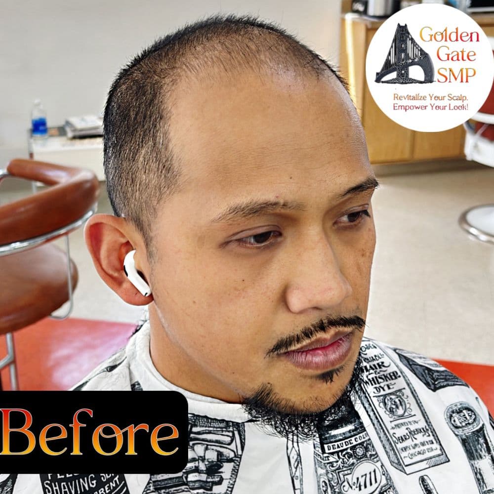 Golden Gate SMP - hair transplant in San Francisco, CA
