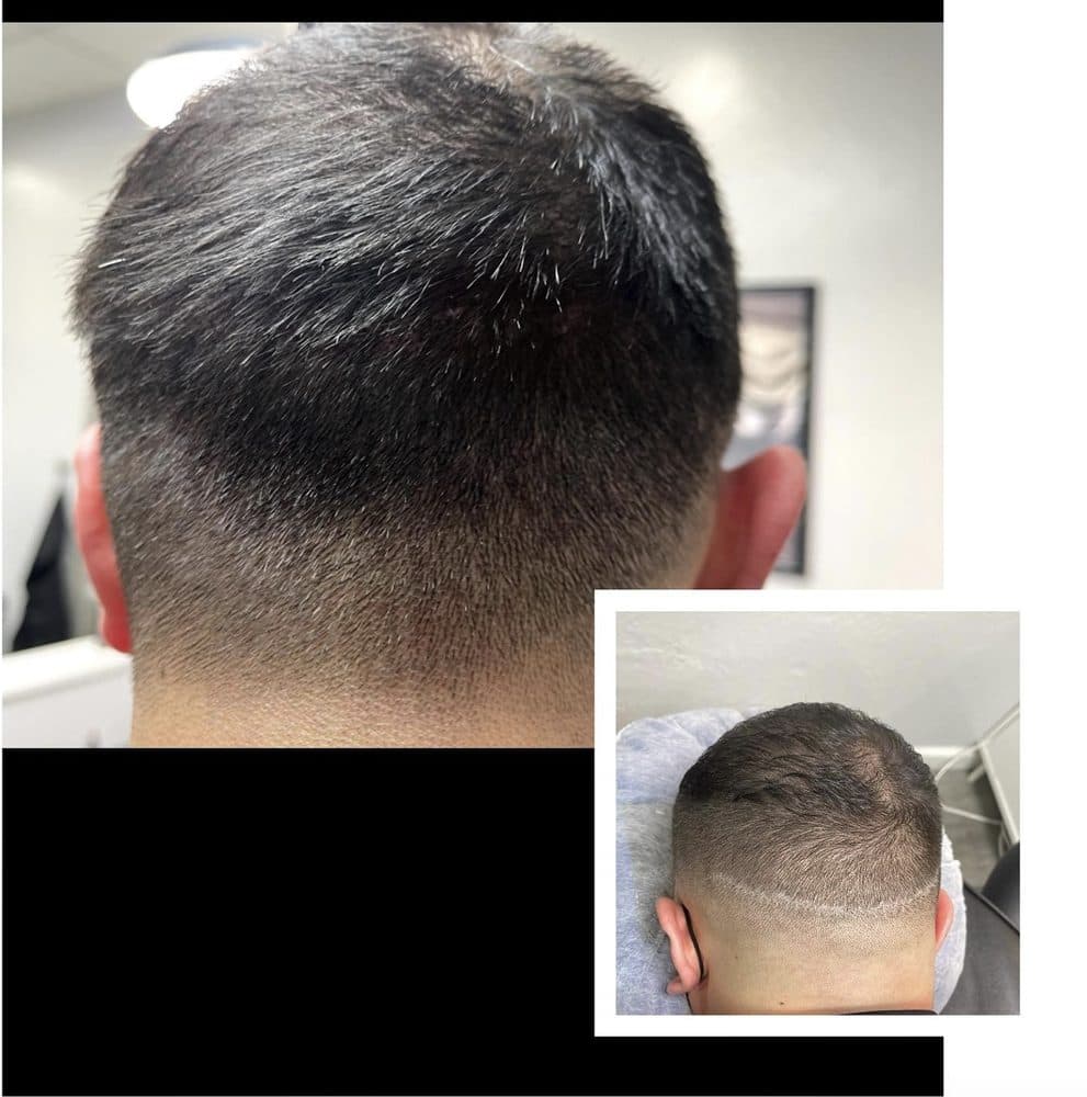 Scalp Ink - hair transplant in Sacramento, CA