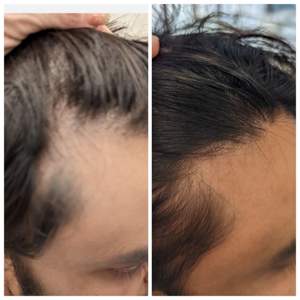 Crown Design - hair transplant in Glendale, CO