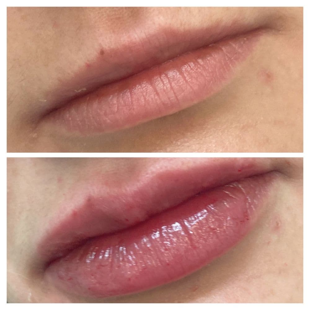 Skinpedia - hair transplant in San Francisco, CA