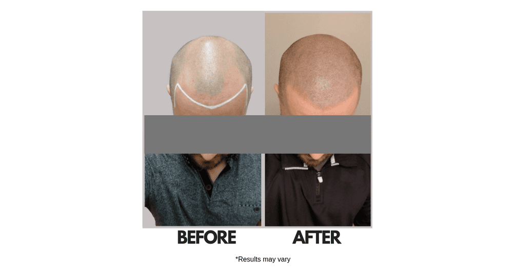 Liechstein-Scalp Micropigmentation - hair transplant in Holladay, UT