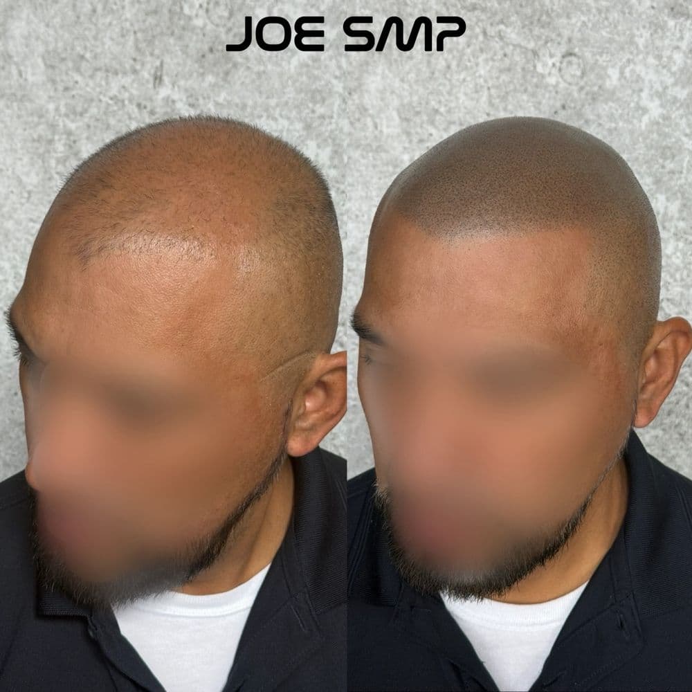 Joe SMP - hair transplant in Clinton Township, MI