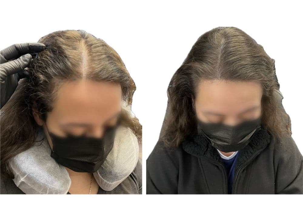 Scalp Ink LV - hair transplant in Las Vegas, NV