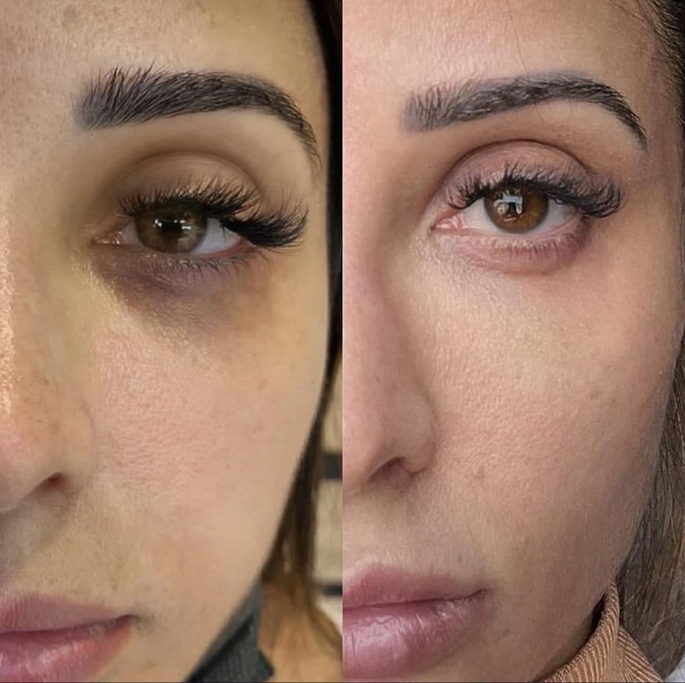 Scar Paramedic - hair transplant in Paradise Valley, AZ