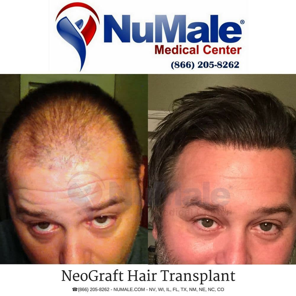 NuMale Medical Center - hair transplant in Tampa, FL