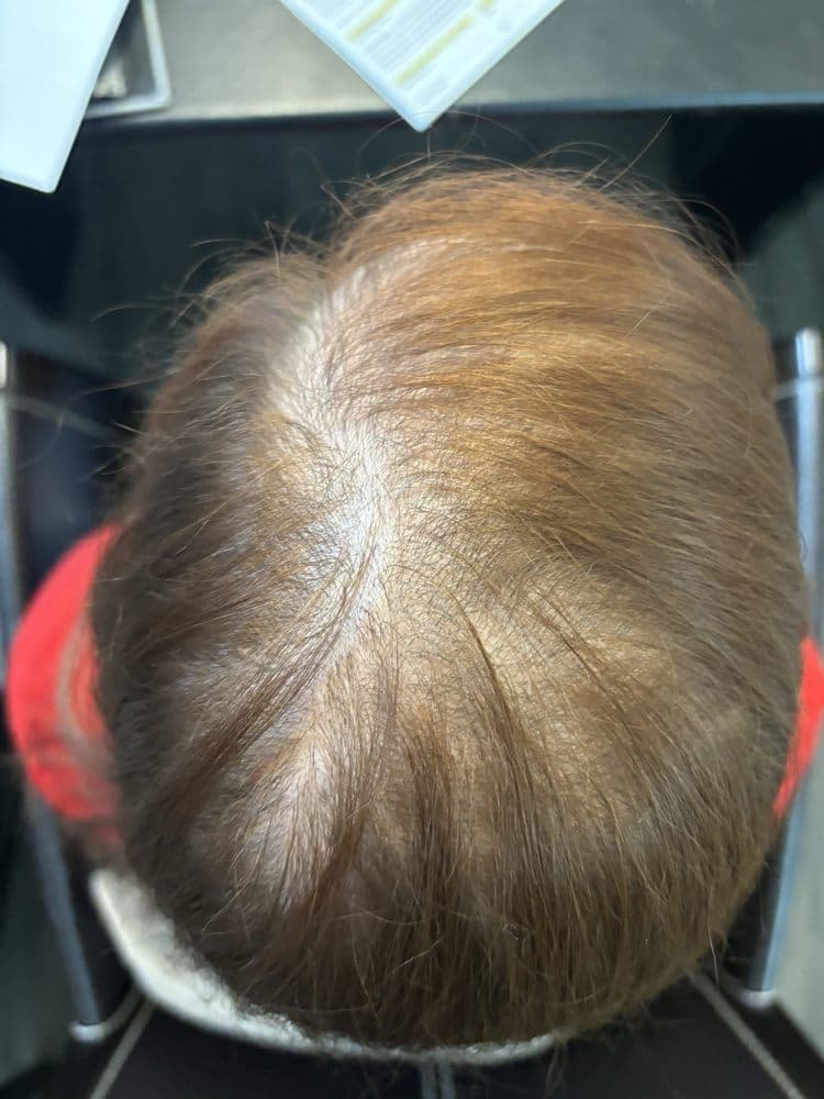 Arizona Aesthetics | Hair Restoration & CoolSculpting - hair transplant in Scottsdale, AZ