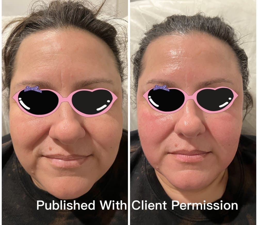 Hummingbird Beauty - hair transplant in San Jose, CA