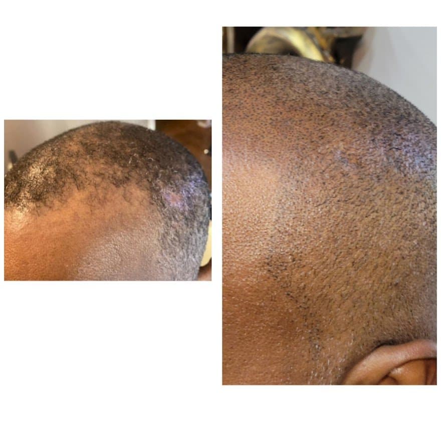Affirmed Crown and Wellness - hair transplant in Duncanville, TX