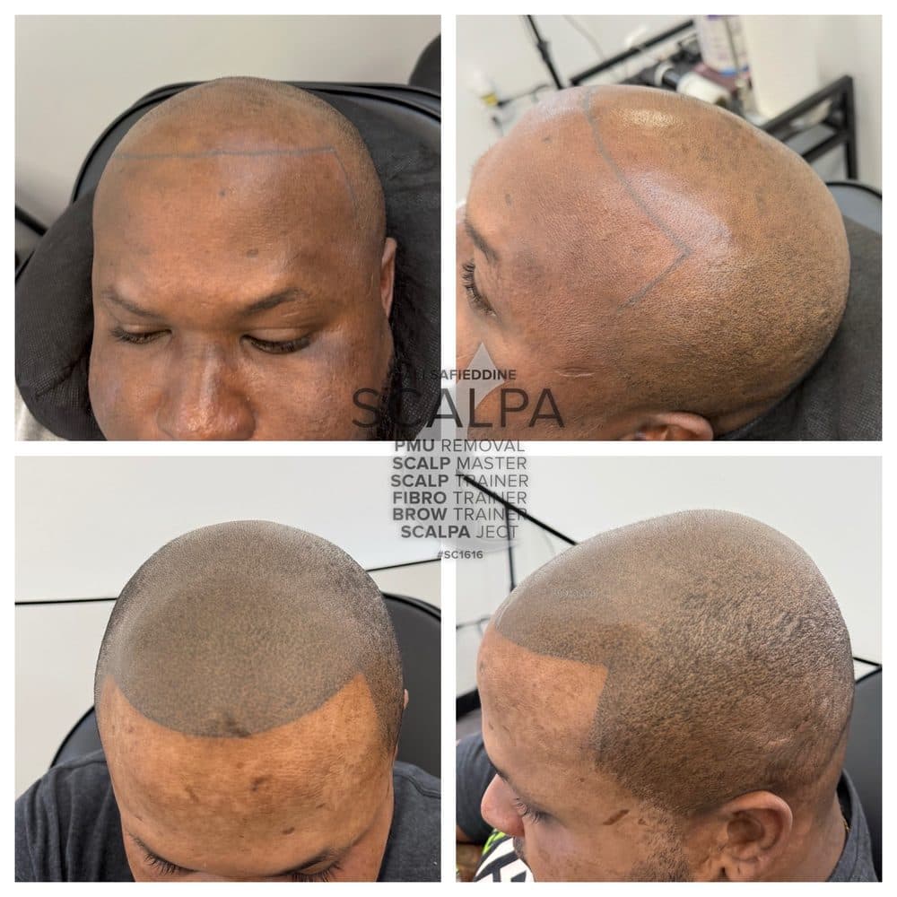 Scalp Aesthetics Dearborn - hair transplant in Dearborn, MI