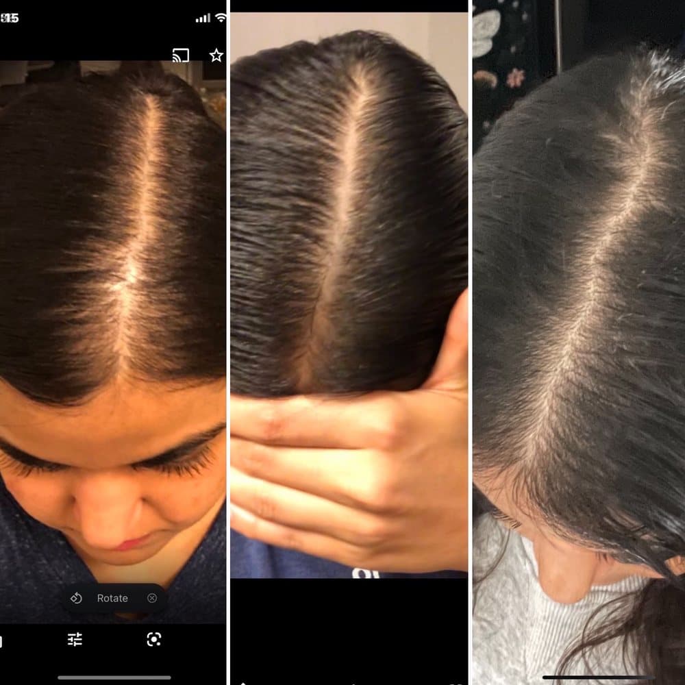 Aesthetic Solutions NY - hair transplant in Forest Hills, NY