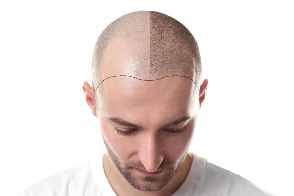Ink2HairLineSMP - hair transplant in Orlando, FL