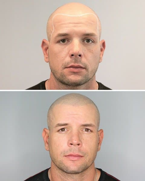 Hairline Ink - hair transplant in San Antonio, TX