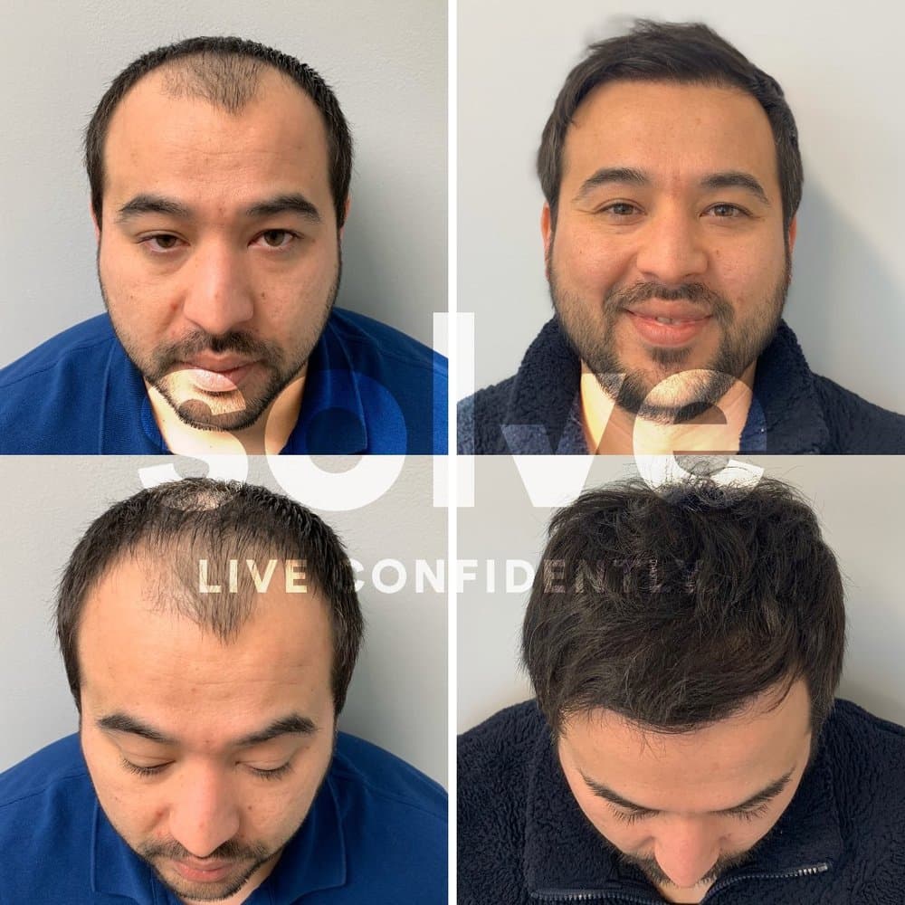 Solve Clinics - hair transplant in Skokie, IL