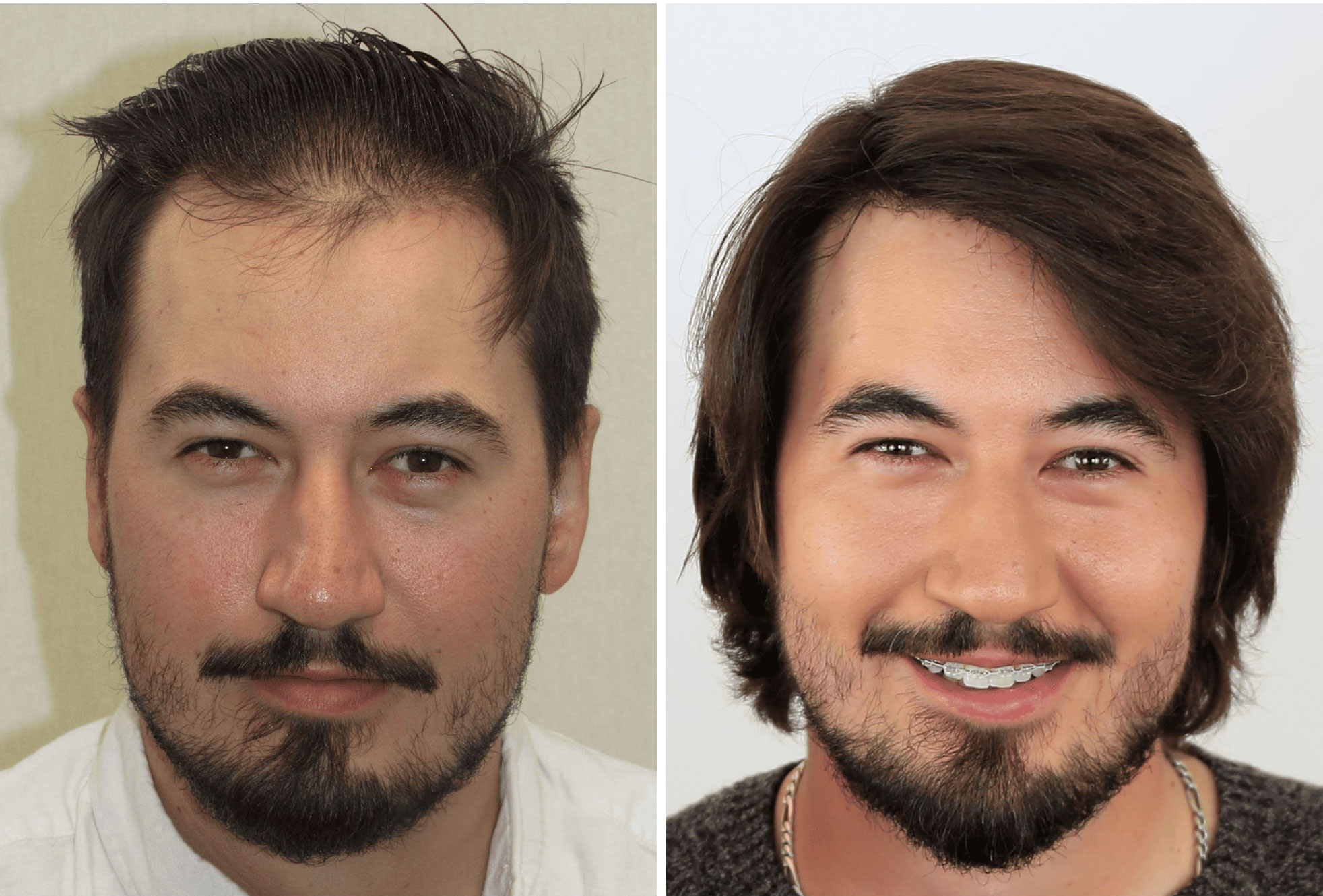 FUE Hairline Transplant Before & After - Case 2