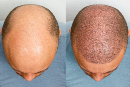 FUE Hairline Transplant Before & After - Case 5